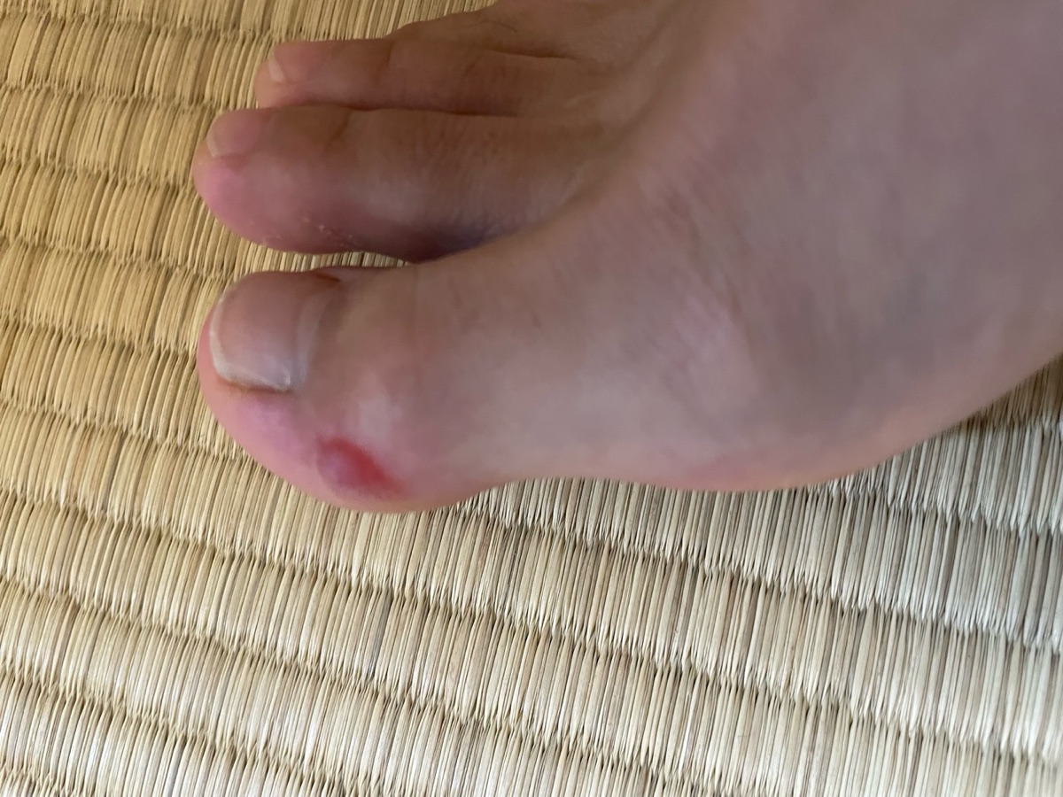 レース後に足の指にできた水ぶくれ